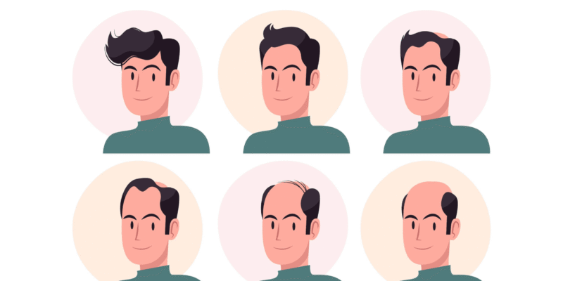 What Causes Male Hair Loss? Simple Science for Beginners